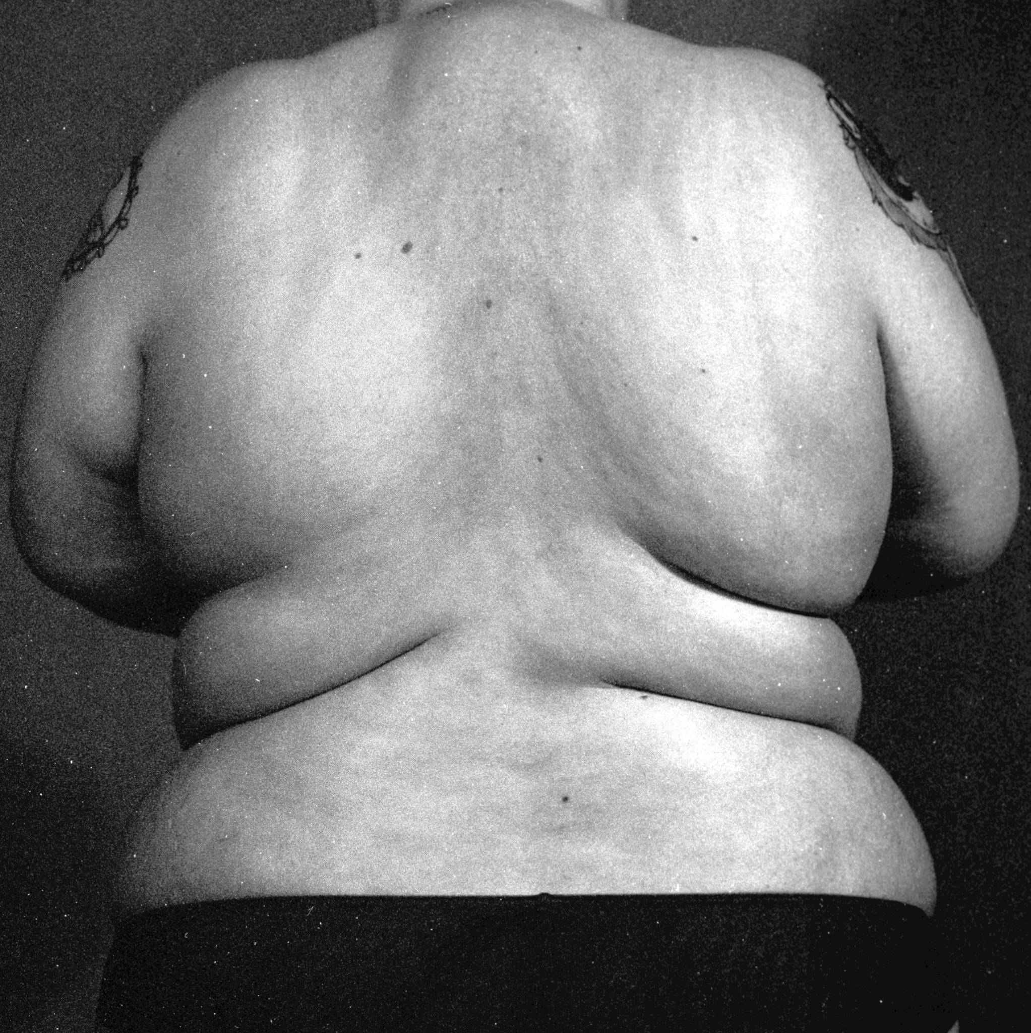 Image shows a black and white image of a person's back, unclothed, with lots of grain